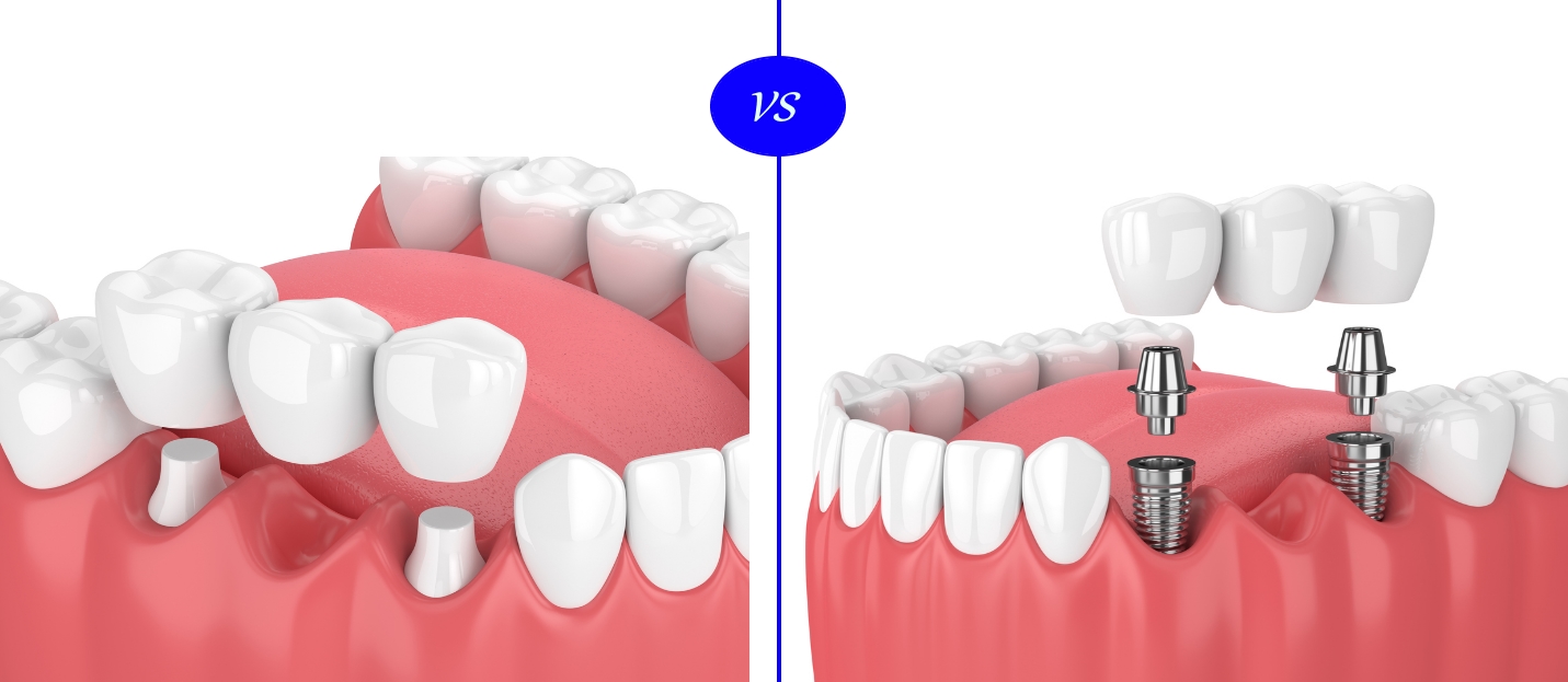 dental-implants-vs-dental-bridge