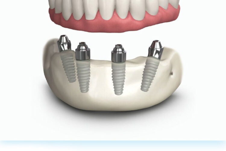 All On Four Dental implant