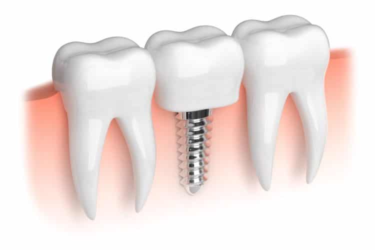 Best-Dental-Implants-Cost-in-Turkey